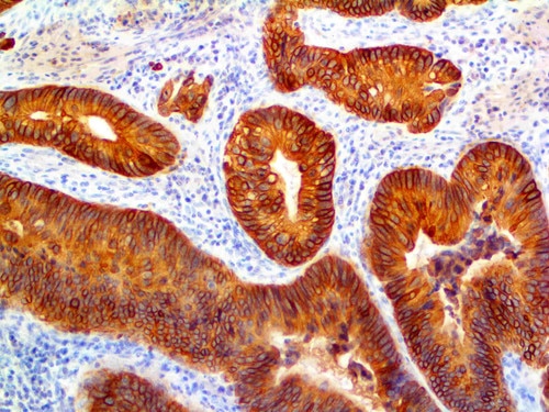 IHC of Cytokeratin 20 on an FFPE Adenocarcinoma Tissue